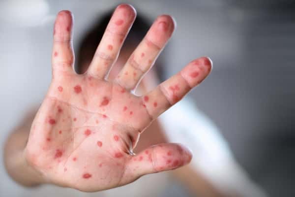 Measles Exposure Alert Issued for Two Edmonton Hospitals as Alberta Outbreak Continues