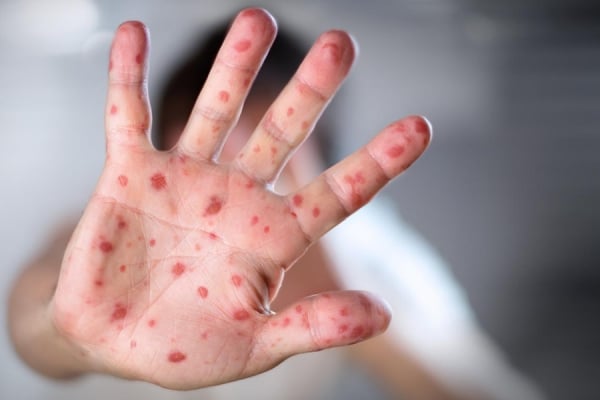 Measles Exposure Alert Issued for Two Edmonton Hospitals as Alberta Outbreak Continues
