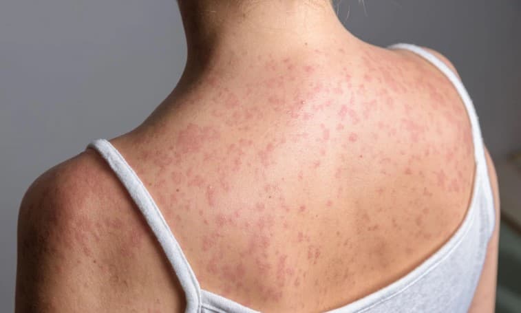 Measles cases rising in Alberta, led by South Zone communities including the Medicine Hat and Lethbridge area