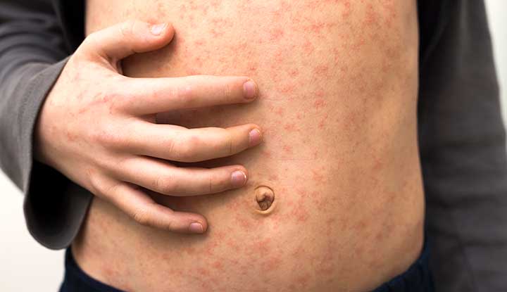 Measles Exposure Reported at Grande Prairie Friendship Centre