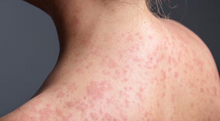 Measles Exposure Confirmed at Grande Prairie Hospital Emergency Department