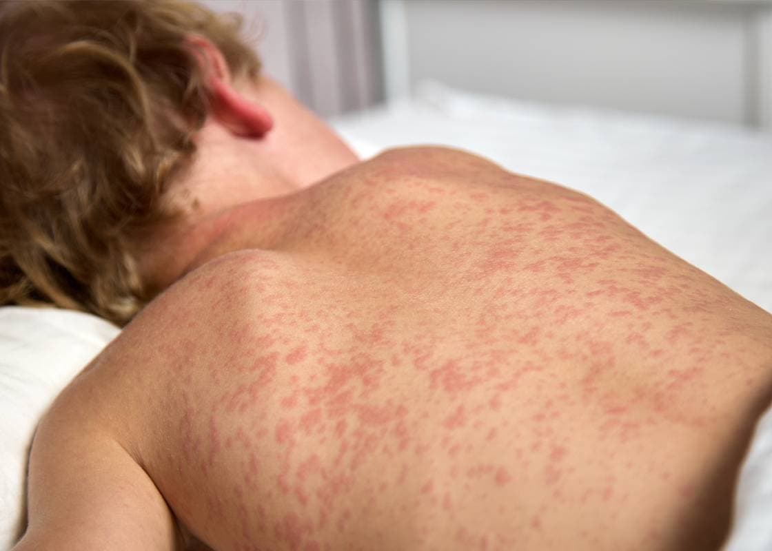 Alberta Health Issues Measles Exposure Alert for Two Calgary Hospitals - Check If You Were There