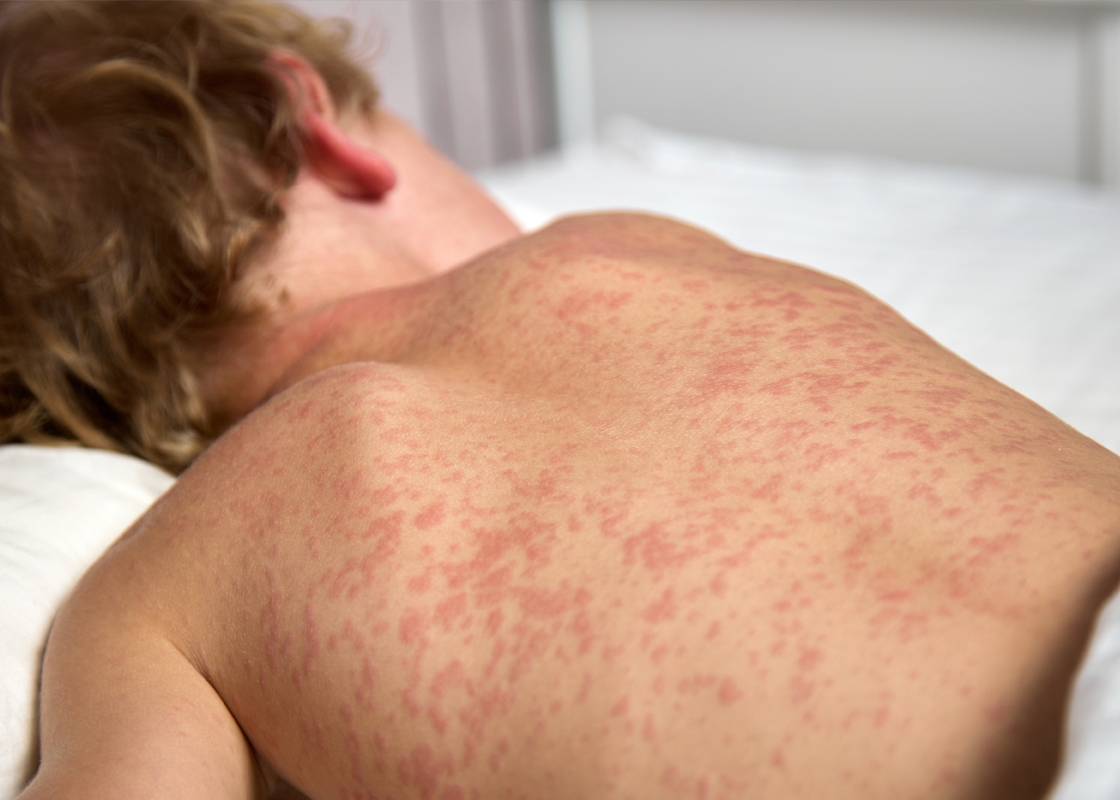 Alberta Health Issues Measles Exposure Alert for Two Calgary Hospitals - Check If You Were There
